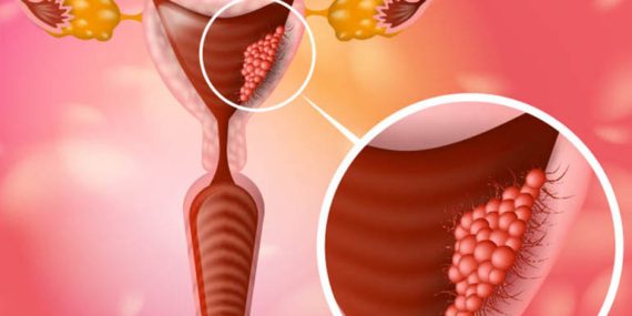 Uzman Op. Dr. Ayça Bozoklar Nuh: “Rahim Ağzı Kanseri Düzenli Taramalarla Önlenebilir”